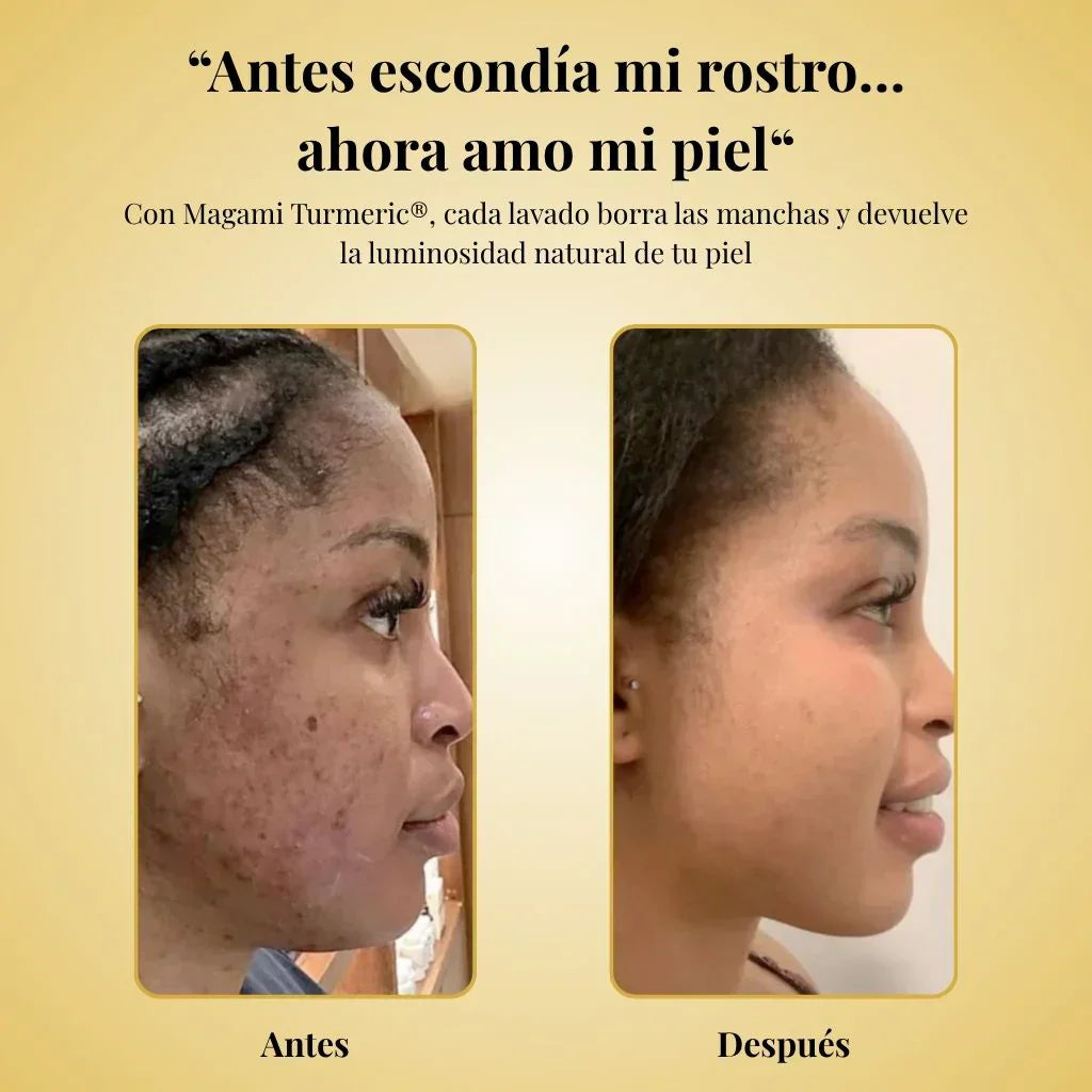 ✨ DESPIGMENTANTE avanzado Magami Turmeric® + ENVÍO GRATIS